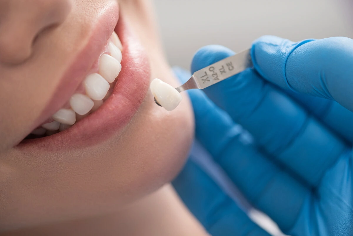 Dentist matching a crown shade guide to a patient's teeth