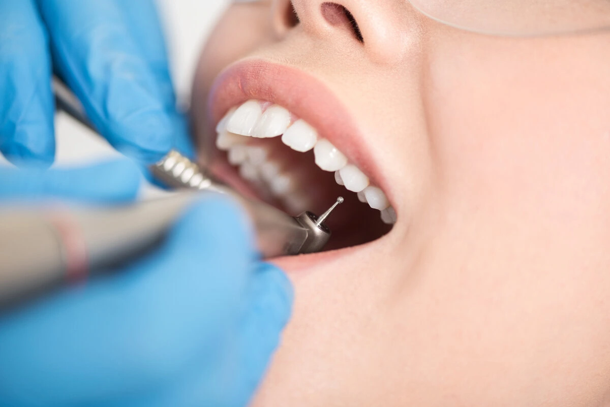 Dentist checking a crowned tooth with a dental mirror
